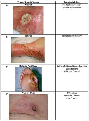 Skin substitutes as treatment for chronic wounds: current and future directions